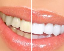 imagen Productos naturales que te ayudarán a blanquear los dientes