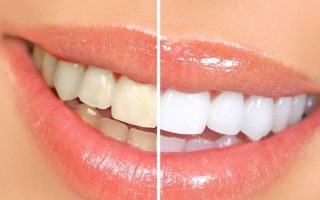 imagen Productos naturales que te ayudarán a blanquear los dientes