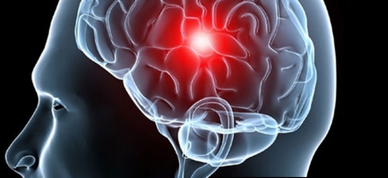 imagen Cómo prevenir un accidente cerebrovascular: 5 Consejos